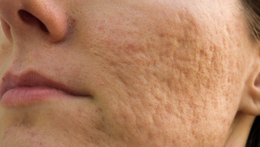 acne scars