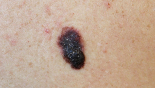 melanoma 3