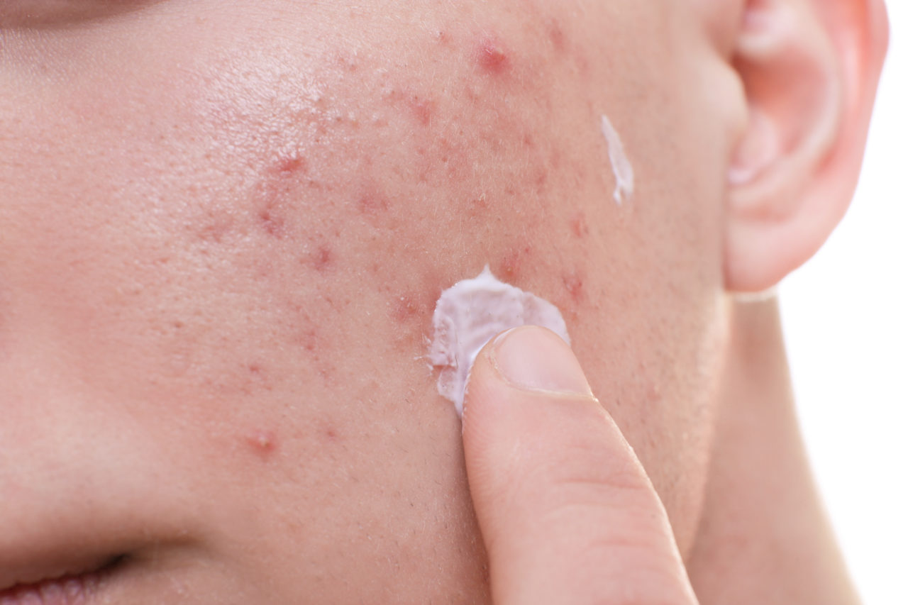 topical-treatments-for-acne