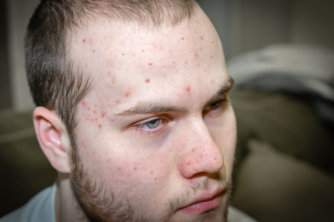 Acne: Understanding What's Happening On the Skin